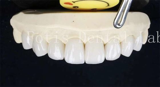 주문 0.3-0.5mm 세라믹 라미네이트 치아 online manufacture