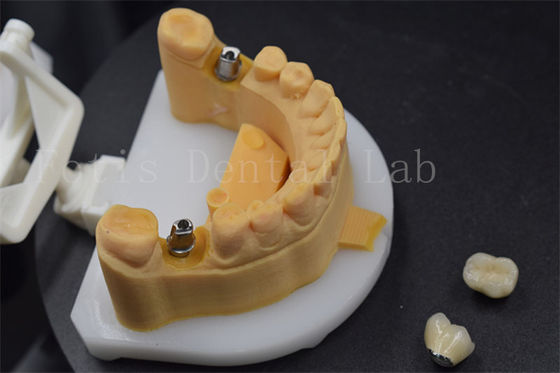 주문 쉽게 지르코니아 치아 왕관 치아를 위한 타이타늄 왕관 online manufacture