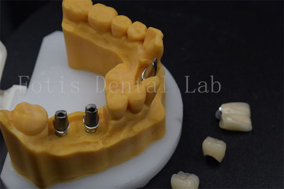 주문 높은 내구성 치아 임플란트 왕관 쉽게 조정 치아 임플란트 가이드 수갑 online manufacture