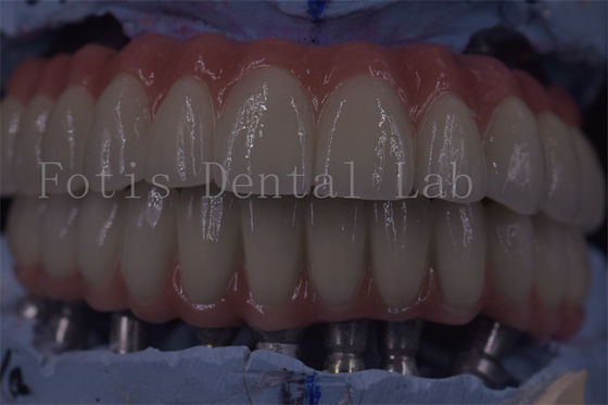 주문 고도 기능 을 위한 첨단 임상 치아 임플란트 왕관 online manufacture