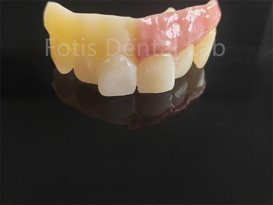 주문 컴퓨터 지원 설계 로 도자기 를 얹은 단층 지르코니아 online manufacture