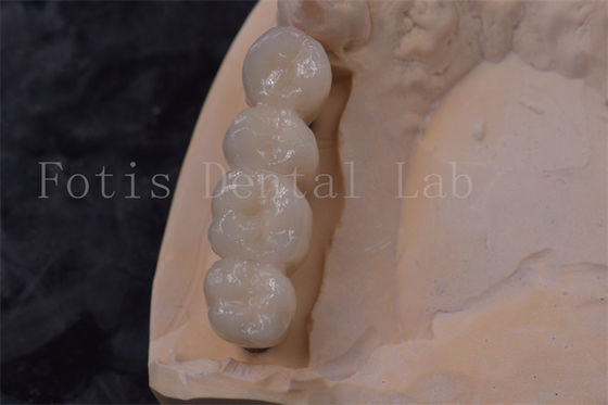 정밀 맞춤 Zirconia 치아 왕관 임플란트 PFM 왕관 청소가 쉽다