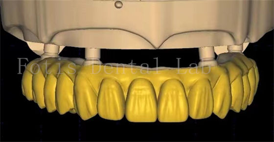 OEM 치과 왕관 설계는 첨단 스캔 및 3D 프린팅 기술을 사용합니다