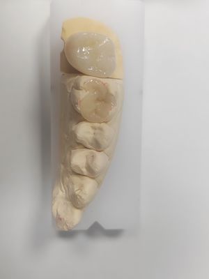 간접 채식 및 치아 색상 회복을 위한 치아 인레이 및 온레이