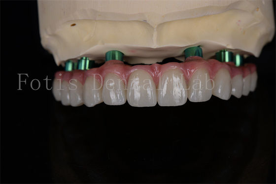 Zirconia All-on-4 임플란트 수술 같은 날 회복 최소한의 후속 치료가 필요합니다